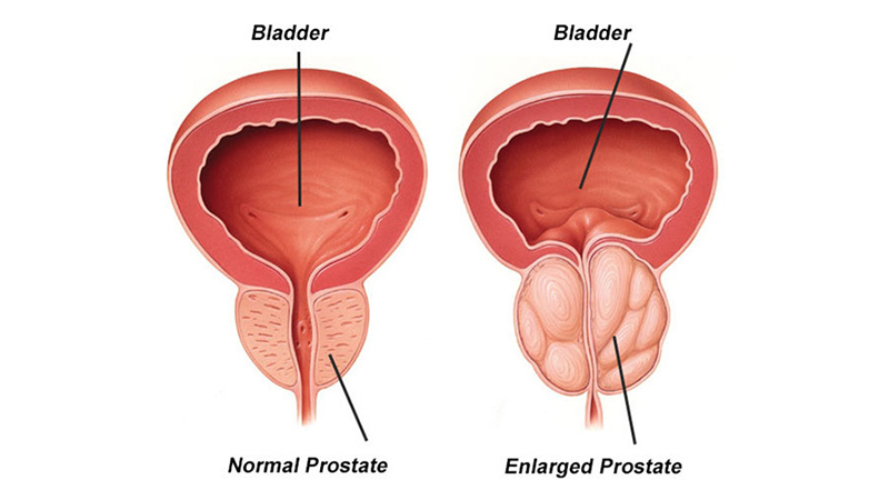Benign Prostatic Hyperplasia Performance In Health