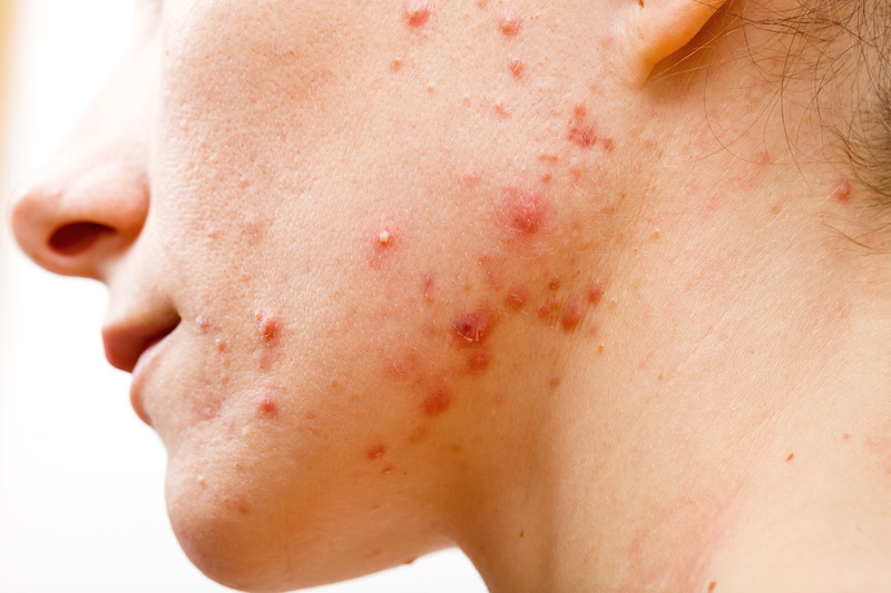 Acne Causes & Strategies to Say Farewell to Acne