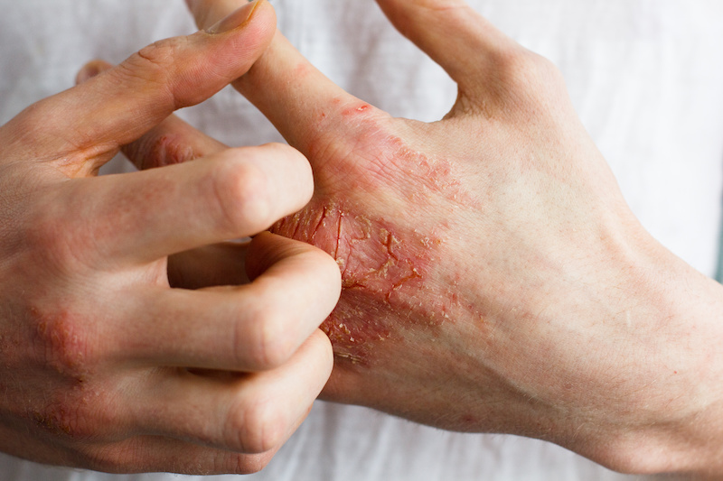 Eczema on hand