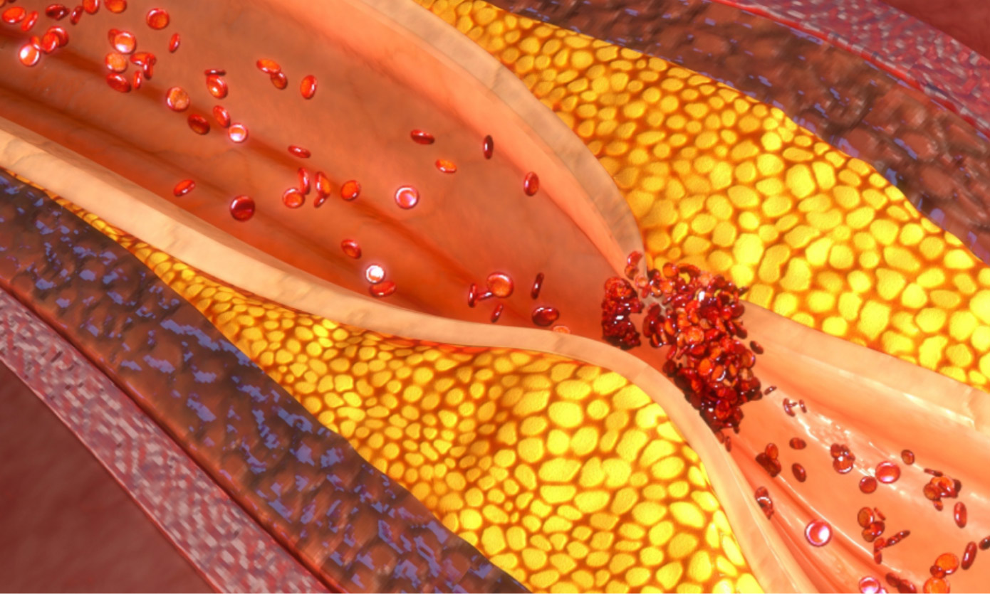 Performance-in-Health_blog_dyslipedemia